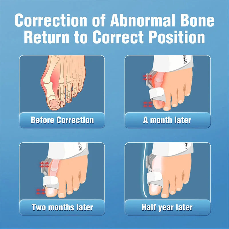 Upgraded Bunion Corrector - 3D Knob Toes Corrector