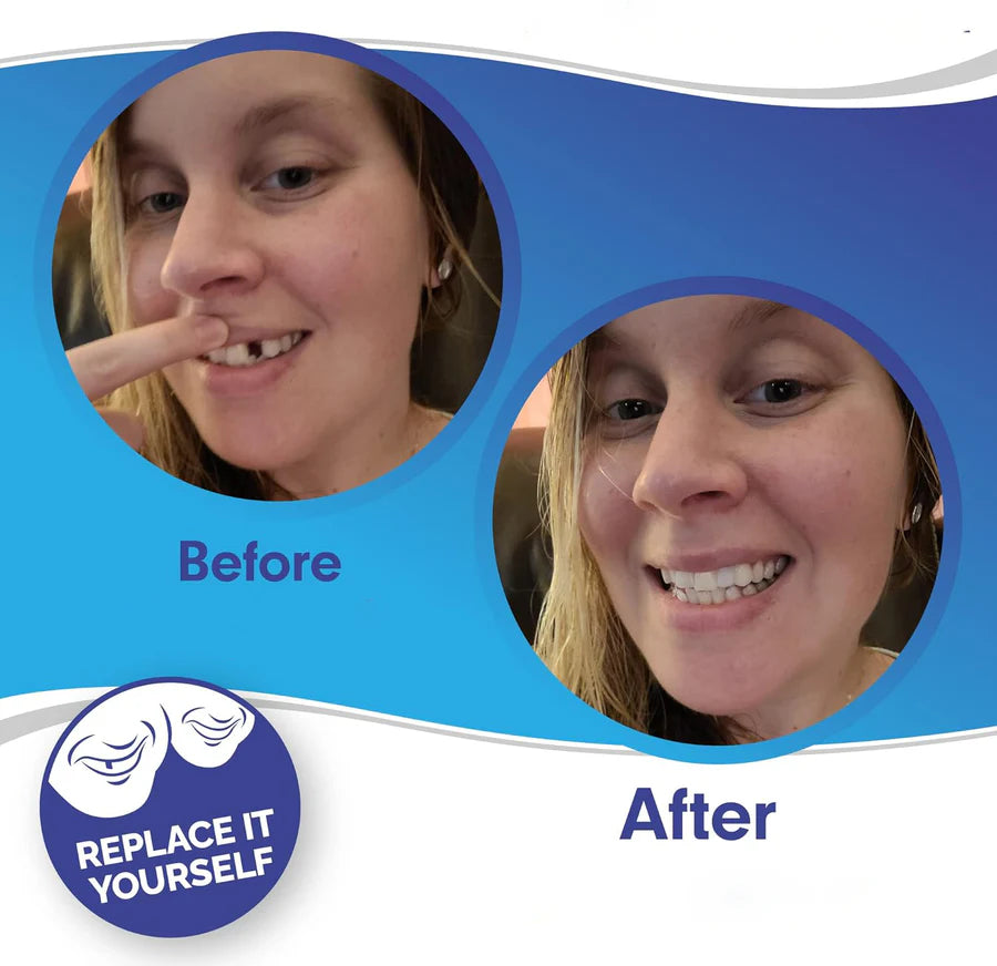 Smile Veneers (Upper & Lower)