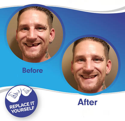 Complete Teeth Veneer Kit Upper Lower Set