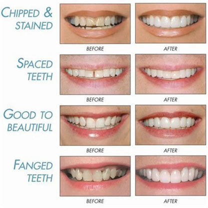 Smile Veneers (Upper & Lower)